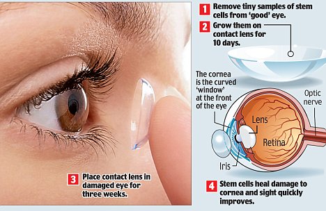 stemcellcontactlens